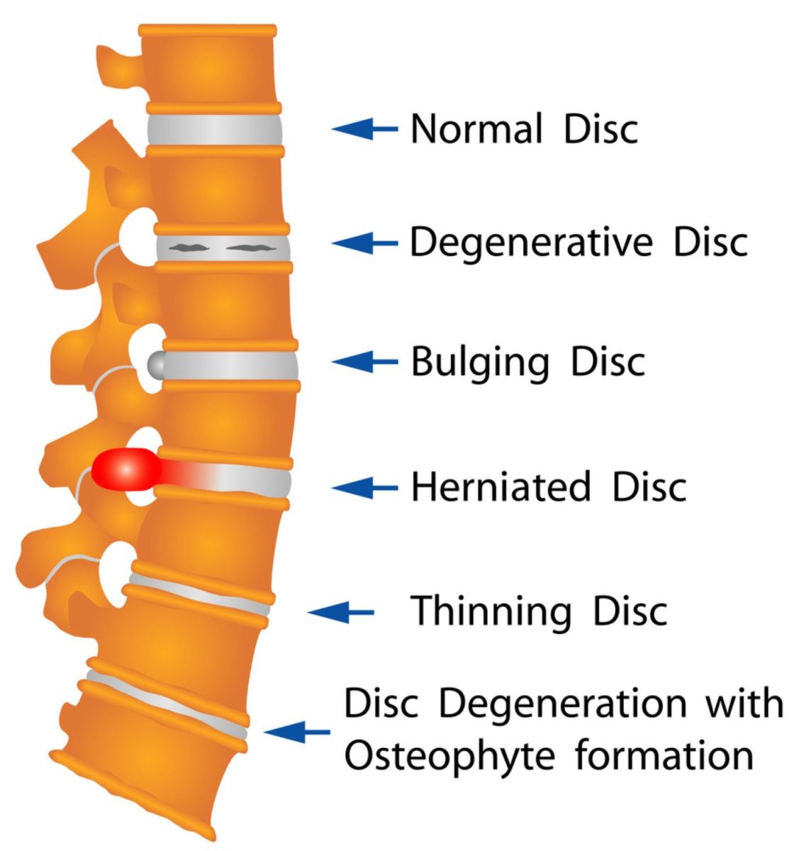Disc Problems