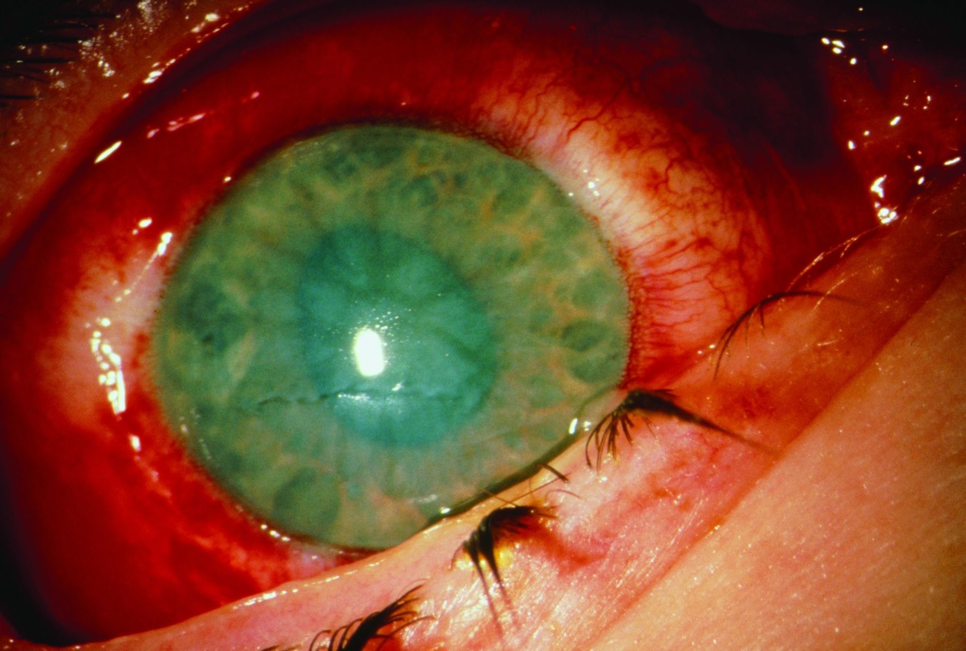 ammonia_burn_eye