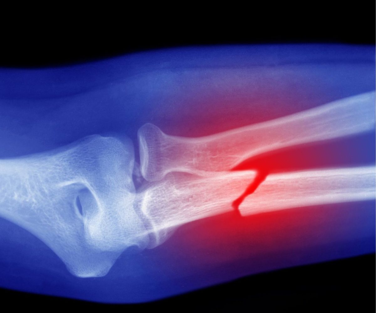 XRAY Fracture (1080 x 900 px)